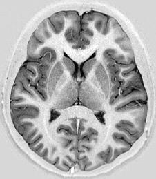 Singulat girus 9) Middle frontal girus Resim