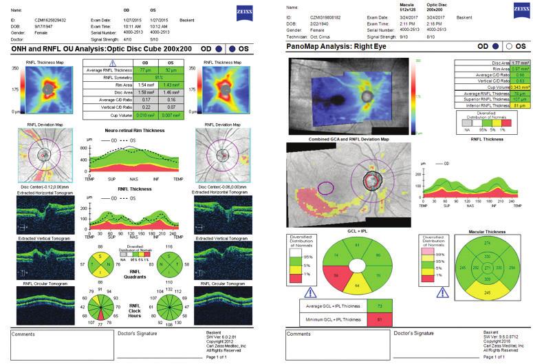 Retina Sinir Lifi tabakasının muayenesi Glokomdaki hasarın temeli optik siniri oluşturan sinir lifi tabakasındaki kayıplardır.