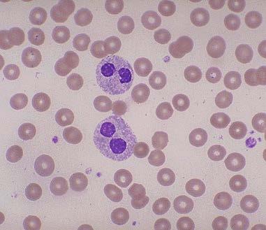 Inherited condition PMN - Spectacles Heterozygous