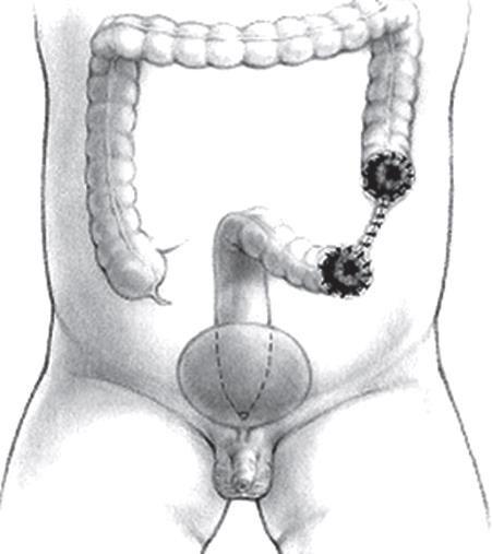 Sigmoidostomi Be eği atı sol alt kadra ı da iki adet ostomi ağzı olur.