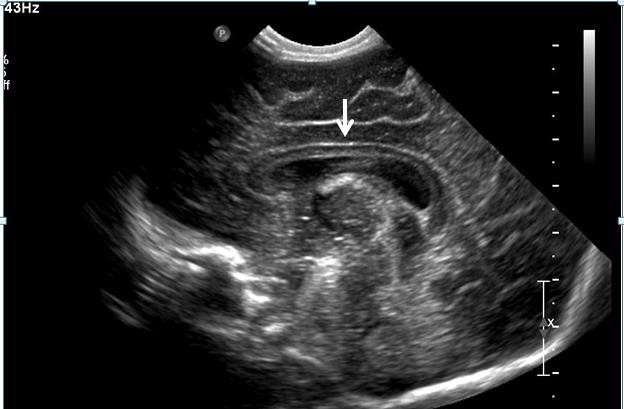 Callosum önünden başlayıp fornix in üst