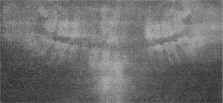 AK Preoperatif panaromik radyograf görüntüsü. Resim 8. AK Postoperatif intraoral cephe görünümü. Resim 6.