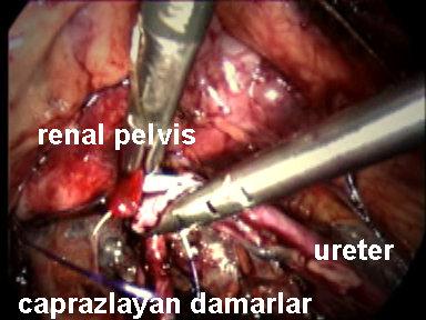 Operasyon Tekniği: Ameliyat öncesi bütün hastalara genel anestezi altında sistoskopi ve retrograd üreteropiyelografi yapıldı. Bu işlemlerin sonrasında hastalara 6 F çift-j kateter takıldı.