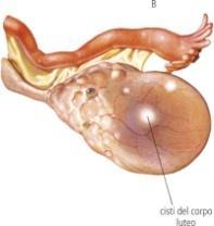 PCOS ve IR; MYO/DCI Oranı MYO DCI OH epimerase OH OVER Hücresel glikoz alımında azalma 2 Oosit kalite ve maturitesinde azalma 2 + Ovaryan fonksiyon üzerine