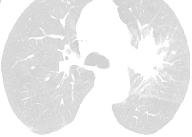 KOAH lı Hastada Preoperatif Değerlendirme Dr.