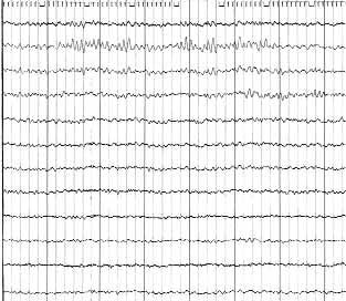 aktiviteleri paroksismal olarak görülmektedir. assen ve ark.