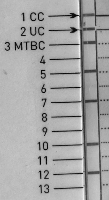 Hastanın doku biyopsisinin mikroskopik incelemesinde aside dirençli basil (ARB) görülmemiş ve gerçek zamanlı polimeraz zincir reaksiyonu (PZR) (GeneXpert MTB/RIF; Cepheid, ABD) testinde M.