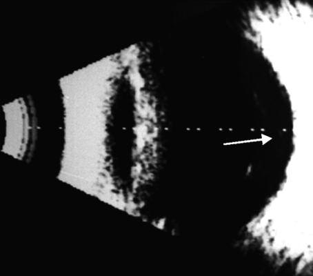 RESİM 4: Kollapsız komplet arka vitreus dekolmanının (ok) B-mod USG görüntüsü. DM nin süresi ve hasta yaşı ile arka vitreus korteksinin durumu arasındaki ilişki Tablo 3 te özetlenmiştir.