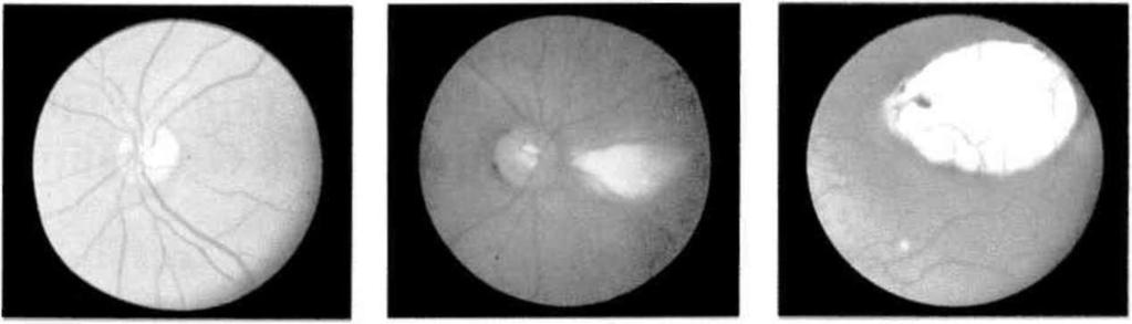 ven dal tıkanıklığı Resim: 11-a Retina ven kök