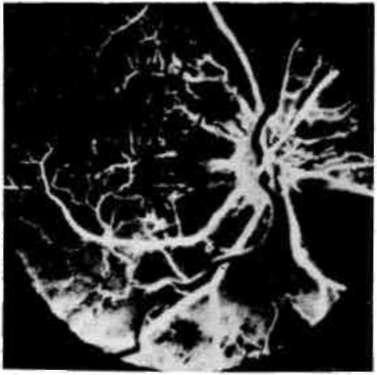 Papilla ödemi Kafa içi basıncının artmasına bağlı papilla ödeminde, oftalmoskopik olarak, diskte yaklaşık 5-7 dioptrilik kabarıklık, sınırlarında silinme, venlerde dolgunluk, kıvrım artışı ve