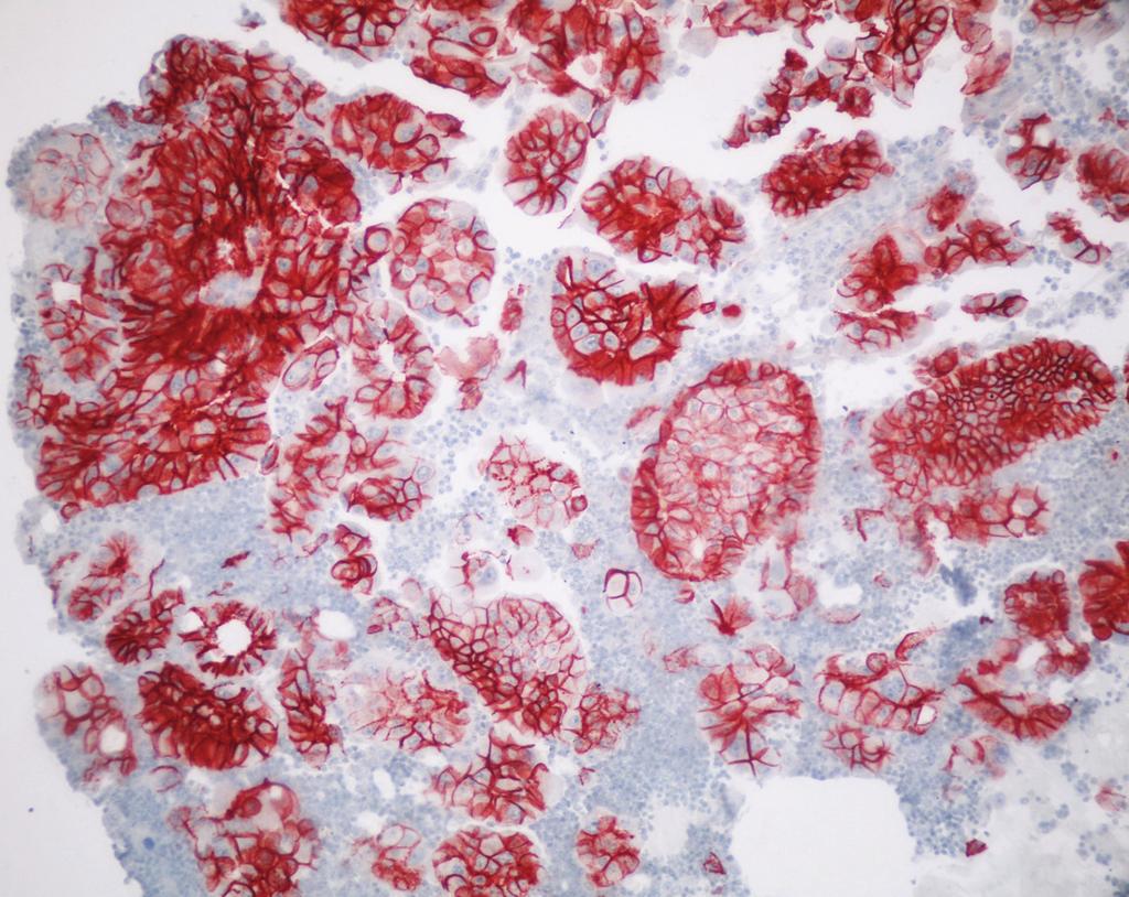 E-kaderin, Kalretinin ve GLUT-1 ekspresyonu vidin, Life Science Division, 110 ml.) damlatıldı; 25 dakika inkübe edildi. Süre sonunda lamlar distile su ile yıkandı; 5 dakika PBS te bekletildi. 7.