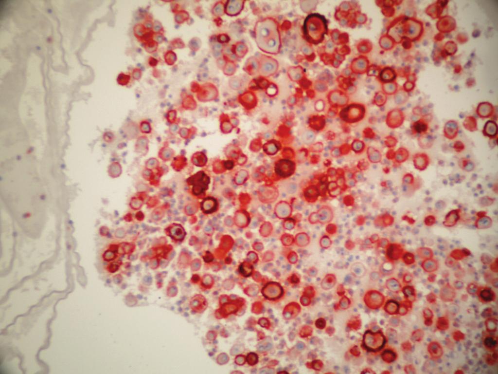 Renkli şekiller derginin online sayısında görülebilir (www.onkder.org) Türk Onkoloji Dergisi Şekil 2. Adenokarsinom hücrelerinde GLUT-1 pozitifliği (x400).