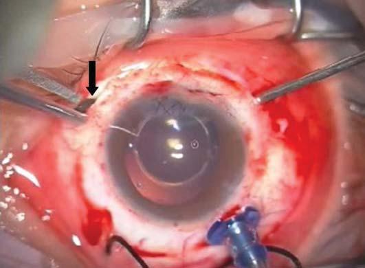 Tüm hastalara kombine cerrahi yapılması yanında, 15 gözün 13 üne fakoemülsifikasyon sonrası IOL implantasyonu uygulandı. Hastaların en son en iyi görmeleri şekil 1 de gösterilmiştir. On (%66.