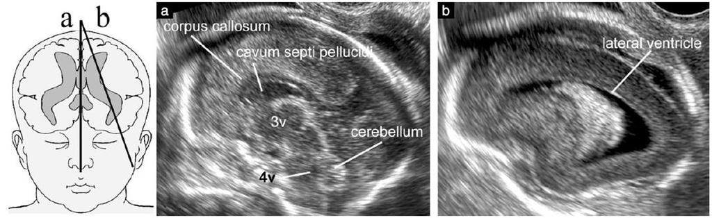 3- Fetal Nörosonogram Kraniyal Sagital Kesitler Midsagittal plan: corpus callosum tüm elemanlarıyla izlenir, cavum septi pellucidi, bazen cavum vergae ve cavum veli interpositi görülür.