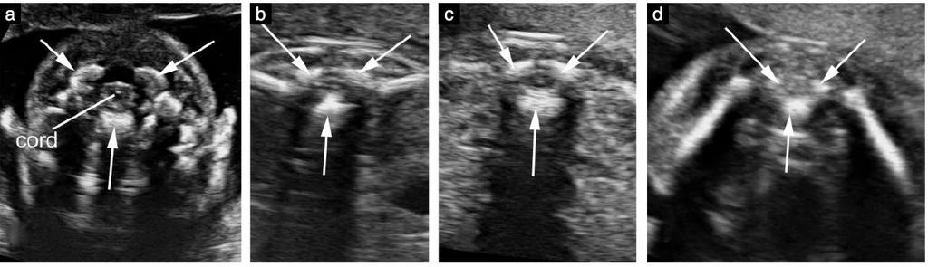 3- Fetal Nörosonogram Vertebra Transverse plan:dinamik olarak prob süpürme hareketiyle tüm vertebra taranır.