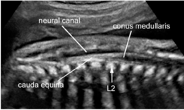3- Fetal Nörosonogram Vertebra Sagital plan: Spinal kanal ve kord