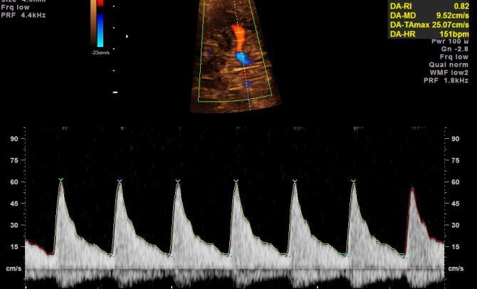 2- Öneriler Fetal Orta Serebral Arter Doppleri İçin Uygun Teknik Nedir?