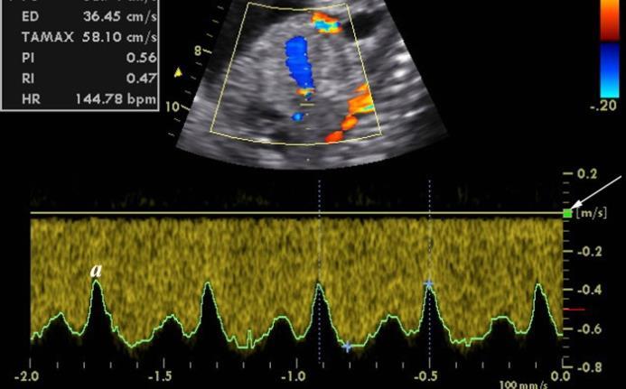 2- Öneriler Fetal Venöz Doppler İçin Uygun Teknik Nedir?