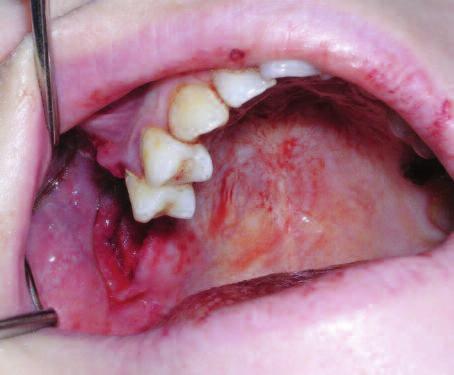 RE SİM 2: Panoramik radyografide sağ üst birinci molar dişinin kök artığı ile ilişkili alt molar dişlere kadar uzanan radiopasiteler göze çarpmaktadır.