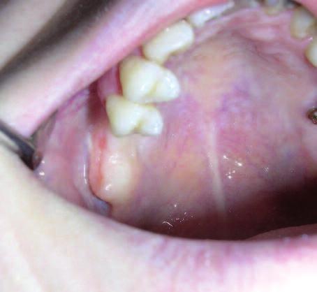 Sekonder iyileşmeye bırakılan yara dudakları sorunsuz olarak birbirine yaklaşmıştır. Radyografik bulgular gibi klinik muyane bulguları da POF teşhisi için yeterli olmayabilir.