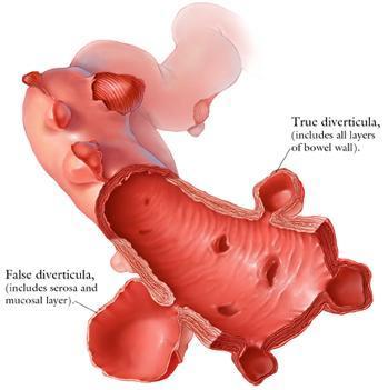 Divertiküler Hastalık: Tipleri Toplumun %25 inde görülür, sıklığı yaşla beraber artar; (40 yaş %<5, 60 yaş %30, 85 yaş %65) Divertiküler Hastalık Ömer ŞENTÜRK Yalancı divertikül (sadece seroza ve