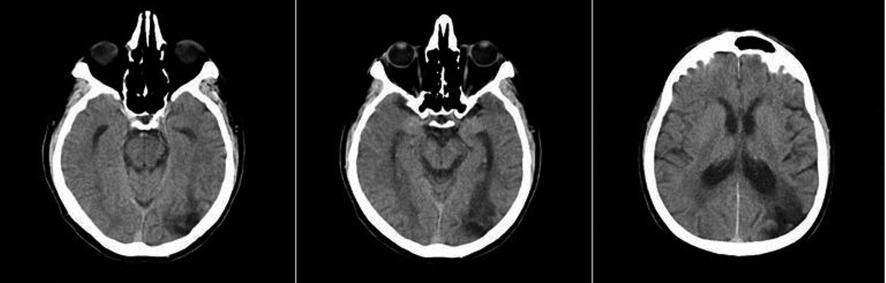 Neurology Köseoğlu et al. RESİM 1: Hastanın kraniyal BT görüntülemesi. Mini Mental Durum Testi (MMDT) nde hastanın okuma ve görsel uzamsal fonksiyonlarında bozukluk bulundu.