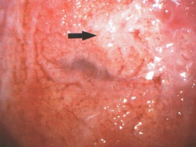 AIS KOLPOSKOPİK BULGUSU Üç bulgu sık İmmatür transformayon zonuna benzeyen papiller yapı En sık