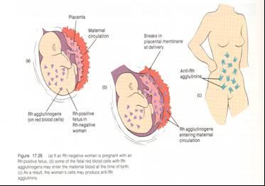 Eritroblastosis fetalis (Yeni doğanın hemolitik hastalığı) Rh (-) bir anne Rh (+) bir bebeğe hamile ise bebeğin Rh antijenleri plasenta yoluyla anneye geçer.