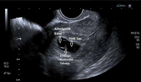 As low as reasonably achievable-alara prensibi fetal ultrasonografi incelemeleri için de uygulanmalıdır [3]. TI 1-1,5 arasında ise tetkik süresinin 30 dk yı geçmemesi önerilmektedir [4]. I Resim 1.