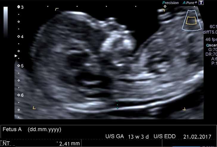Türk Radyoloji Derg 2017; 36: 1-10 Gürses ve Okşar. İlk trimester obstetrik ultrasonografi I Resim 7. Mid-sagittal kesitte nuchal translüsensi (NT) ölçümü, örnek 2 I Resim 8.