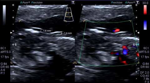 Gürses ve Okşar. İlk trimester obstetrik ultrasonografi Türk Radyoloji Derg 2017; 36: 1-10 I Resim 9. Nuchal cord varlığında nuchal translüsensi (NT) ölçümü I Resim 10.