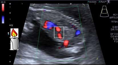 Gürses ve Okşar. İlk trimester obstetrik ultrasonografi Türk Radyoloji Derg 2017; 36: 1-10 önerilmektedir [8]. 10.gebelik haftasında FKH 170 düzeyindedir. Trizomi 13 de FKH olguların %85 de 95.