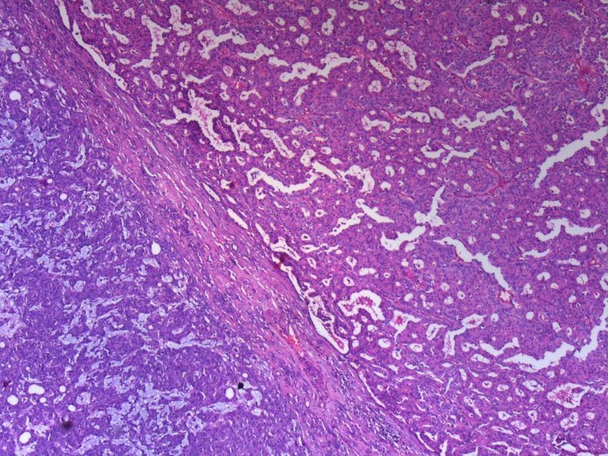 carcinoma) (HEx40) Figure 5C Adenocarcinoma NOS-like domain (HEx40) The patient suffered no complications in