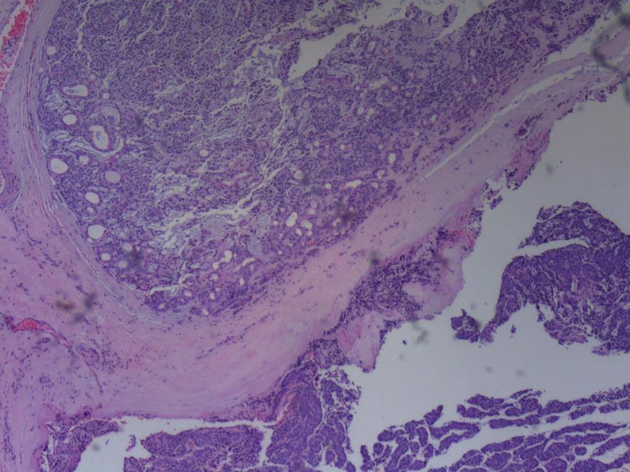 Discussion Pleomorphic adenoma is the most common form of tumor in the parotid gland.