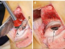 Tertiary osteochondral