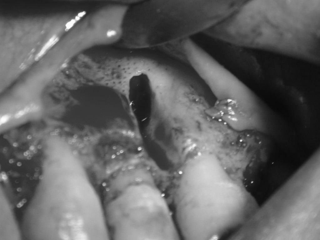 Resim 2. Giriş kavitesinin açılması ve kavitenin tespiti. Resim 3. Kavite tabanının guta-perka yardımı ile radyografik olarak tespiti.