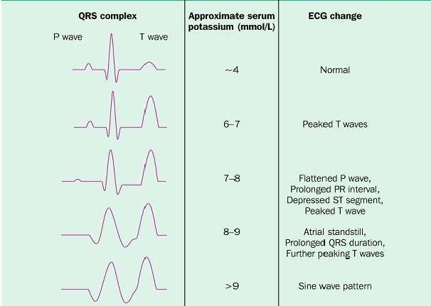 EKG değişiklikleri Normal Sivri T dalgası P dalgasında düzleşme PR uzaması ST