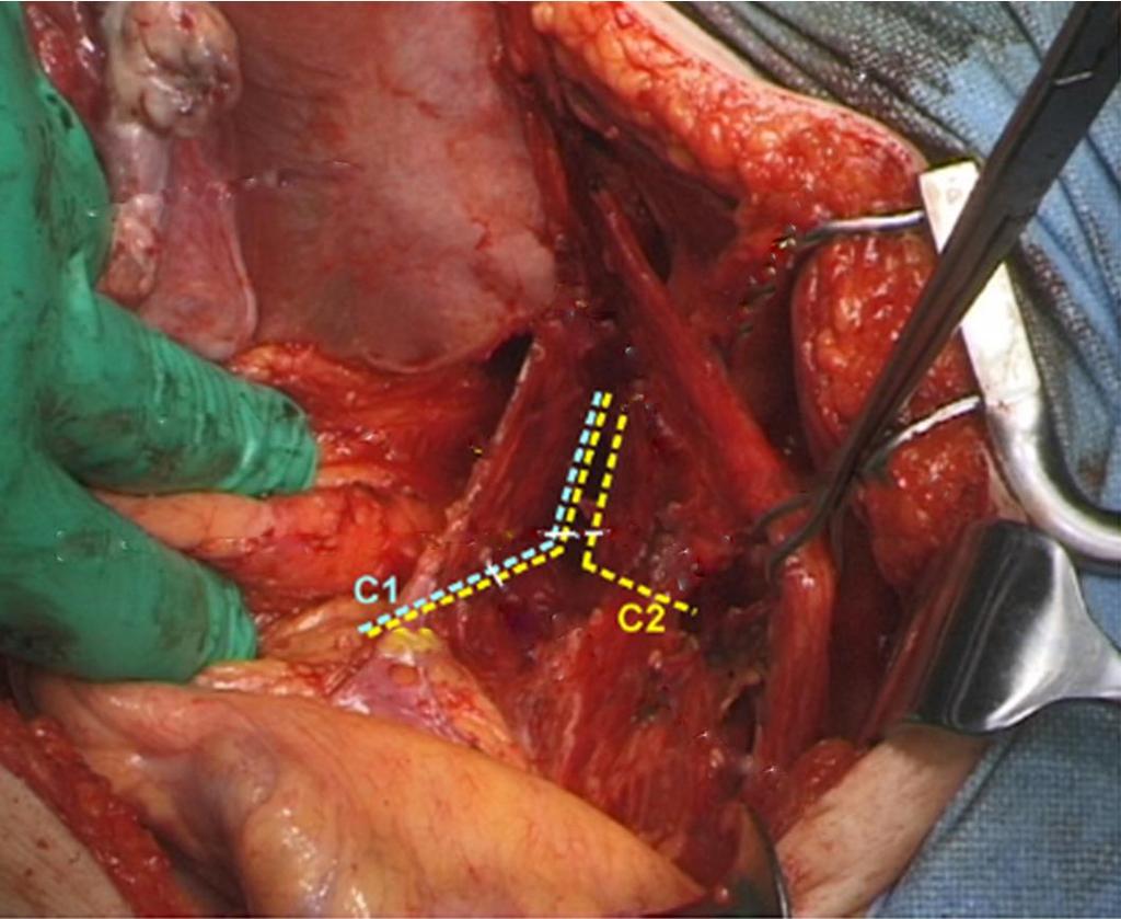 Sinir koruyucu cerrahinin gelişimi Cibula, 2011 Q-M sınıflandırma sistemindeki rezeksiyon tiplerinin vertikal (longitudinal) sınırları tanımlandı Dorsal
