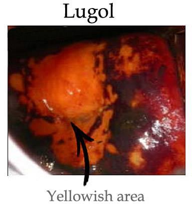 8 Lugol Solüsyonu Uygulanması Yanlış Pozitiflik