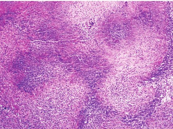 Tutulan damar duvarında nötrofil lökosit infiltrasyonuna ek bazen fibrinoid nekroz dikkati çeker. Hastalarda hemoptizi ve yaygın pulmoner infiltrasyonlar izlenir (8,9). 2.