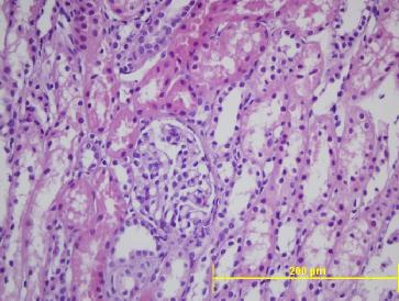 düşmediği için atlamış oldukları fokal segmental glomerulosklerozu (FSGS), IgM nefropatisi olarak değerlendirmiş olabileceği yorumunda bulunmuştur (53).