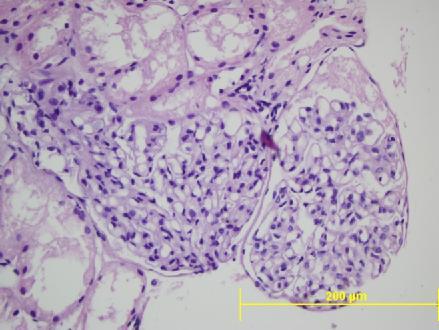 f) Histopatoloji bulguları: İzole IgA nefropatisi, IgM nefropatisi, izole MzPGN li olguların böbrek biyopsisindeki mezangial