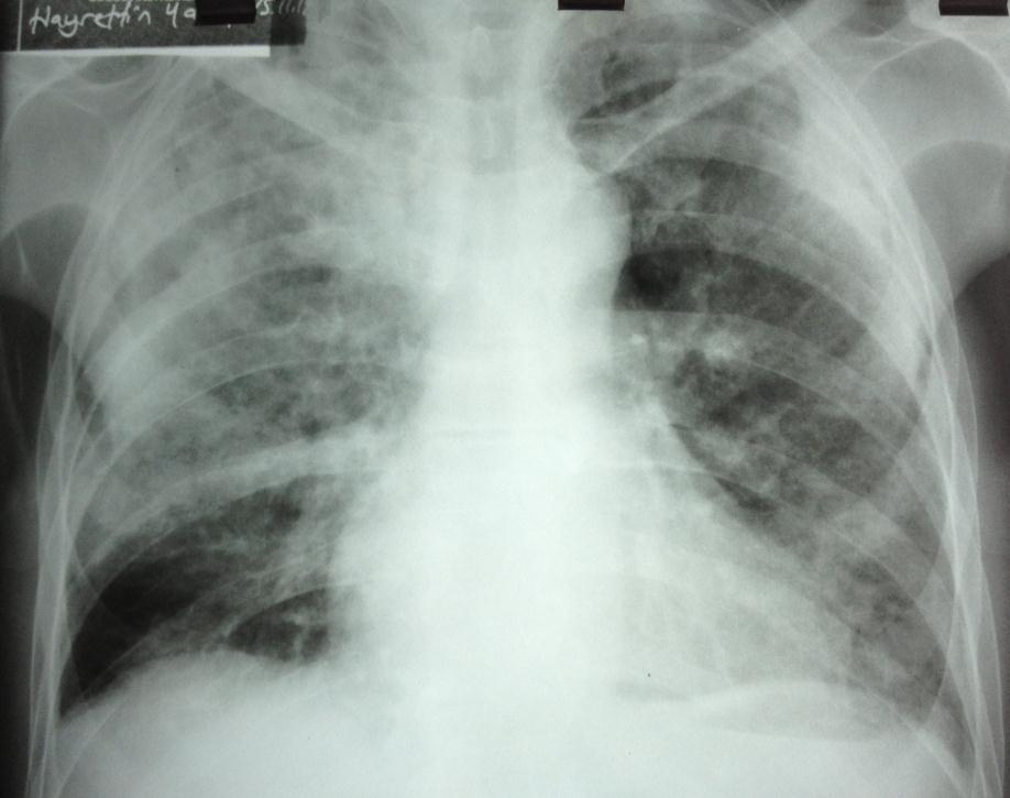 Akciğer kanserli hastalarda