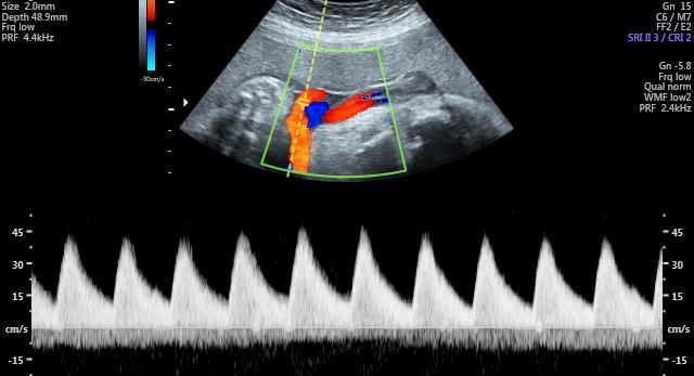 etkiyi gösterir ve olumsuz neonatal sonucu öngörür