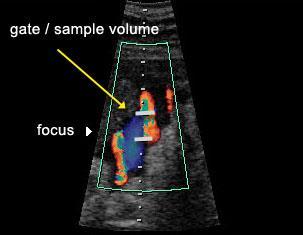 Doppler Ayarları Kayıtta, fetal hareket/solunum olmamalı Ses dalgası kan akış yönüyle aynı çizgide olmalı (insonasyon açısı 0 ) (genellikle <