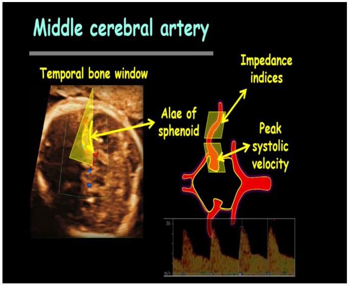 Orta Serebral Arter(MCA) Talamus ve sfenoid kemiğin kanatlarını içeren aksiyel kesit alınarak renkli Doppler ile