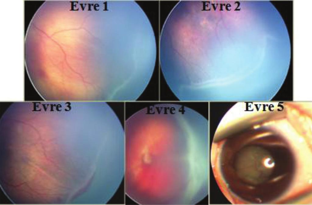 106 Prematüre Retinopatisi Tedavisi güçleşebilir. Retina değerlendirmesi sırasında damarlar optik diskten çıkışlarından itibaren perifere doğru takip edilmelidir.