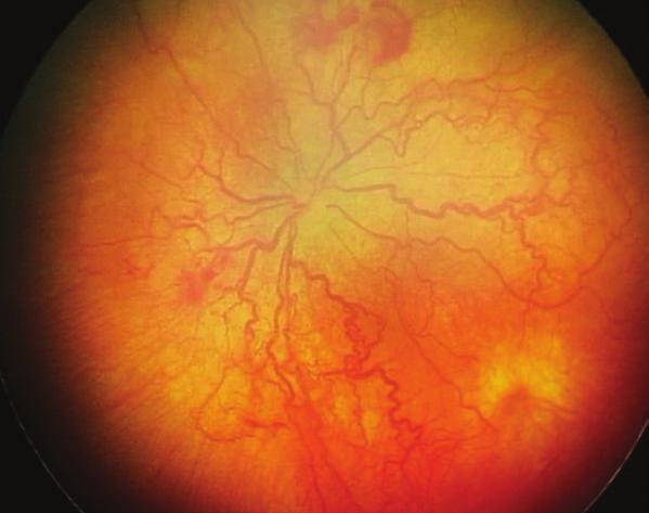 107 Ret-Vit Özel Sayı 2015;23:103-112 Tedavi; avasküler retinanın, vasküler retina sınırına kadar koagüle edilmesi prensibine dayanır, kanamadan kaçınmak için sınıra tedavi uygulanmamalıdır.