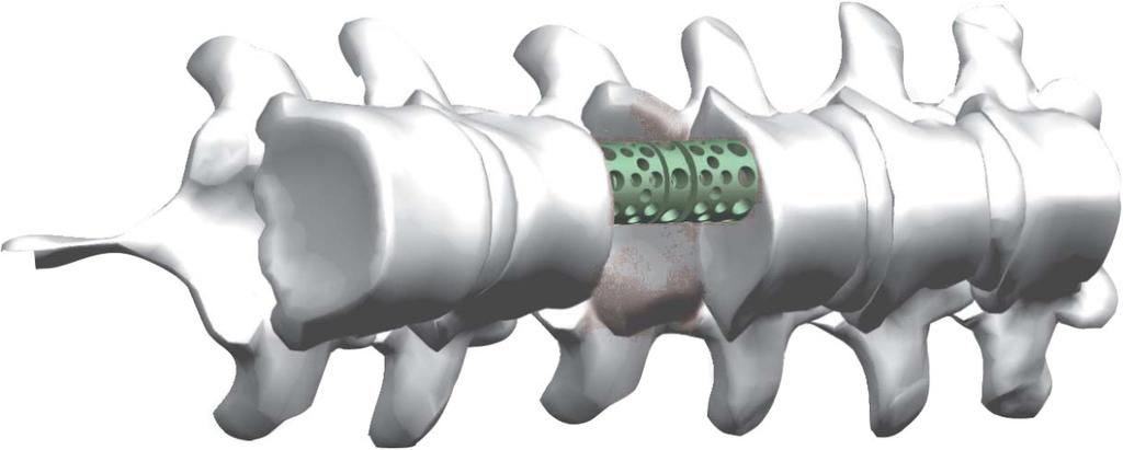 EPANDABLE CORPECTOMY CAGE Attention / Dikkat CORPECTOMY CAGE ENEKFANDABIE Check fitting and positioning of the implant. TR implantın sıkılığını ve pozisyonunu kontrol ediniz.