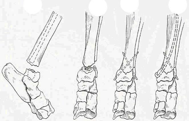 30 Şekil 1.16. Malleolar Kırıklarda Çapraz Pin Uygulaması (Piermattei, D.L. ve ark. 2006: Handbook of Small Animal Orthopedics and Fracture Repair; 4th Ed.